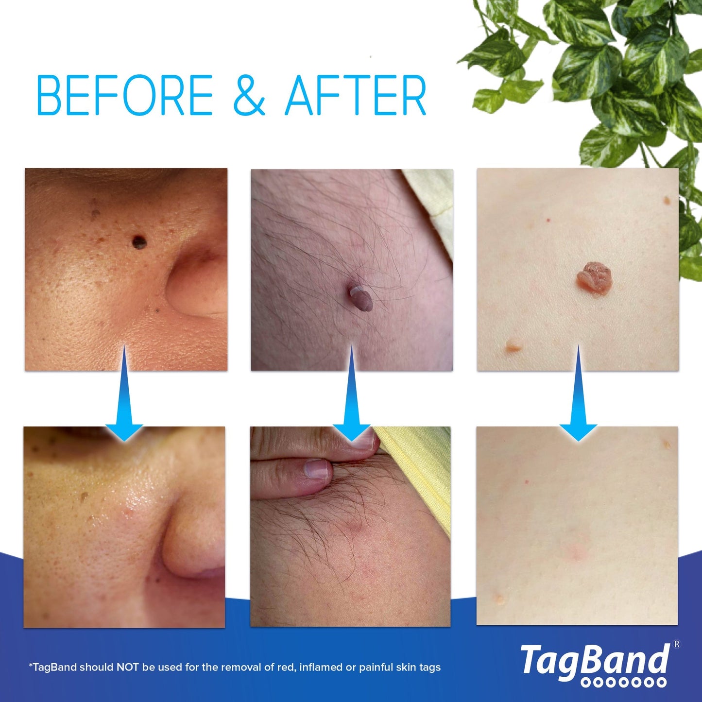 Auto TagBand® - Skin Tag Removal Kit